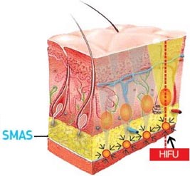 ハイフを効かせる筋層（SMAS）とHIFUの図