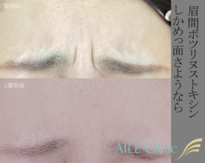 眉間ボツリヌストキシン 症例写真 AILE Clinic