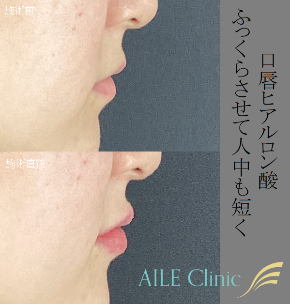 口唇ヒアルロン酸 症例写真 AILE Clinic