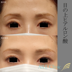 ヒアルロン酸注入 エールクリニック上野御徒町
