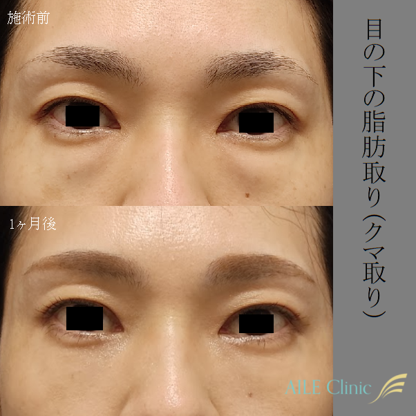 茶クマをなくすレーザー治療の概要【メリットデメリットも解説 