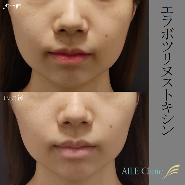 エラボトックスで失敗 注射してから噛むとポコっと膨らむ原因と対処法 エールクリニック Aile Clinic