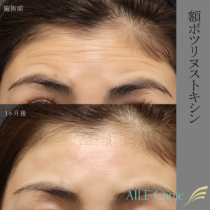 額ボツリヌストキシン症例写真術前と1ヶ月後