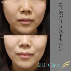 エラボツリヌストキシン症例写真施術前と1ヶ月後
