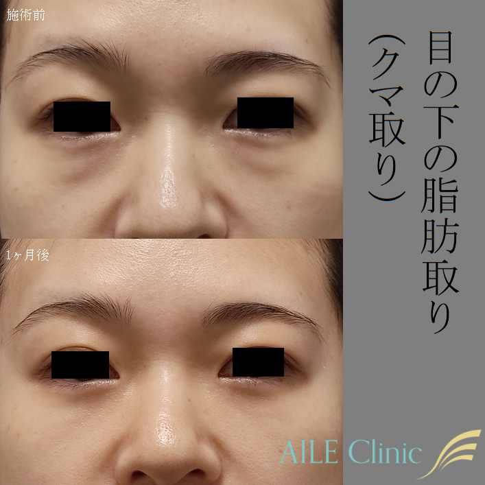 目の下の脂肪取りの施術前と施術1ヶ月後の症例写真