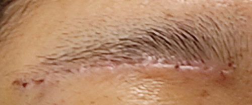 眉下切開抜糸直後の傷跡の写真（眉下切開の施術から1週間後）