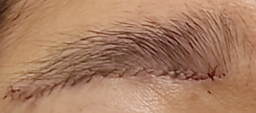眉下切開施術直後の傷跡の写真
