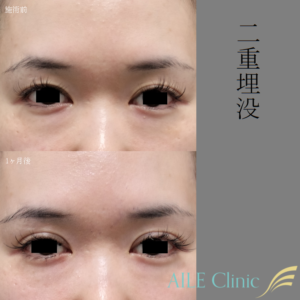 二重埋没症例写真施術前と1ヶ月後