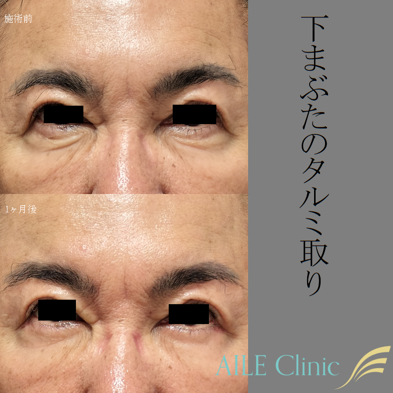 下まぶたのタルミ取り（下眼瞼除皺術）の症例写真（施術前と1ヶ月後）
