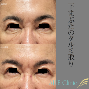 下まぶたのタルミ取り（下眼瞼除皺術）の施術前と1ヶ月後の症例写真