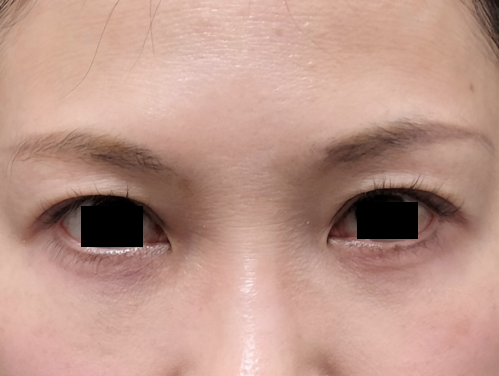 他院での表ハムラ法でクマが治らなかった患者に対して下眼瞼脱脂術で修正手術を行った施術2ヶ月後の症例写真
