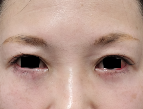 他院での表ハムラ法でクマが治らなかった患者に対して下眼瞼脱脂術で修正手術を行った施術直後の症例写真