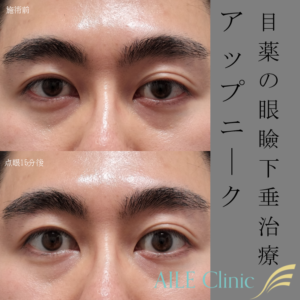 アップニークミニ点眼施術前と点眼15分後の症例写真