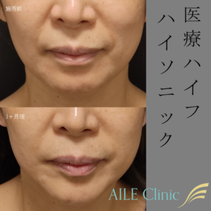 ハイフ施術前と1ヶ月後の症例写真