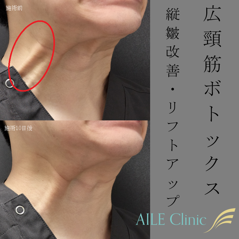実際に広頸筋に力を入れて首にスジが出ている状態と広頸筋の一部にのみ（赤色の楕円部分）ボツリヌストキシンを注射して10日後の症例写真