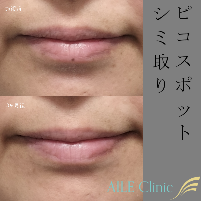 口唇のシミに対するピコスポットの施術前と施術3ヶ月後の症例写真